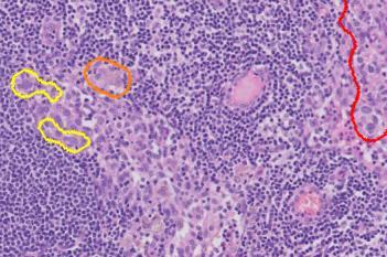 Metastasis Detection, AI