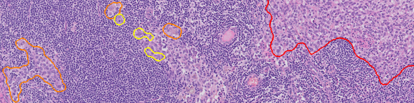 Metastasis Detection, AI