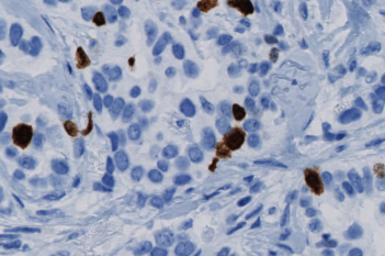 Ki-67 APP, Breast Cancer