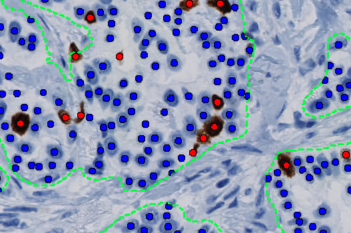 Ki-67 APP, Breast Cancer