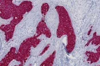 Invasive Tumor Detection (PDS)