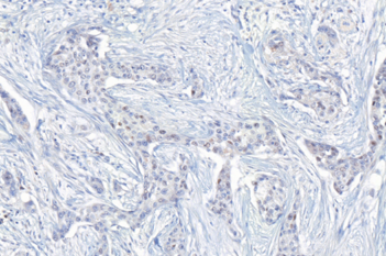 ER, Breast Cancer, AI