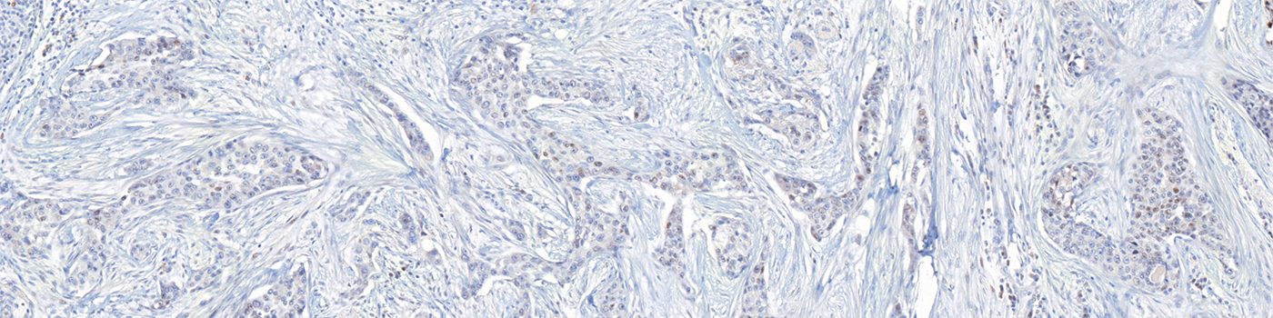 ER, Breast Cancer, AI