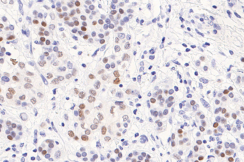 PR, Breast Cancer, AI