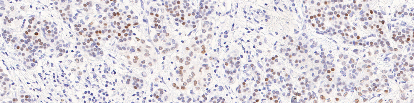 PR, Breast Cancer, AI