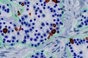 Ki-67, Breast Cancer, AI