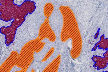 Invasive Tumor Detection (PDS)