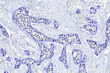 ER, Breast Cancer, AI