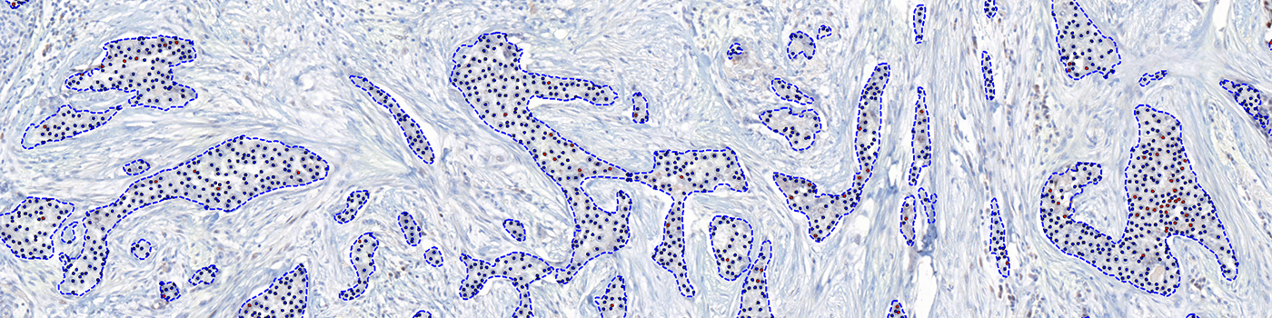 ER, Breast Cancer, AI