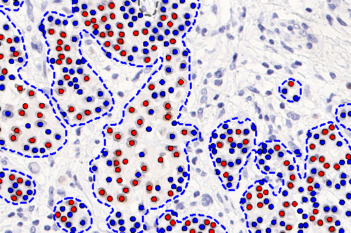 PR, Breast Cancer, AI