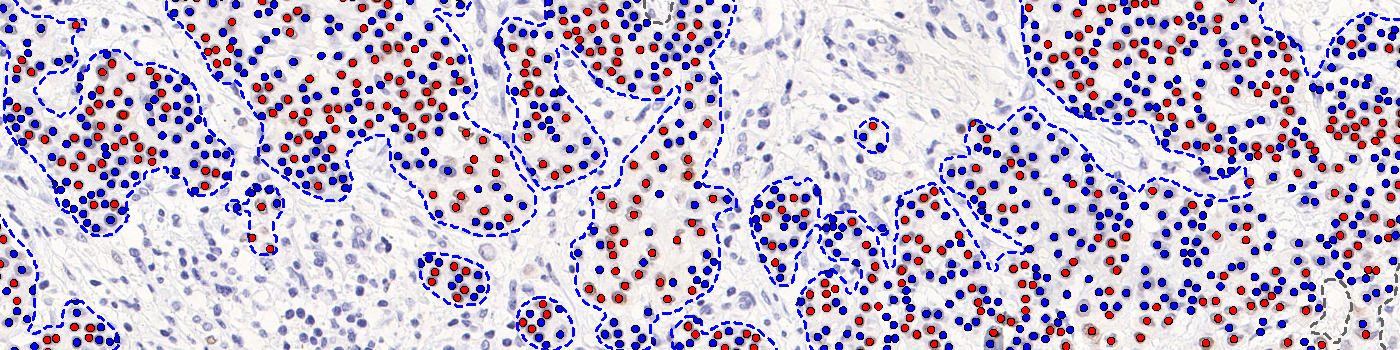 PR, Breast Cancer, AI