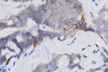 HER2 APP, Breast cancer