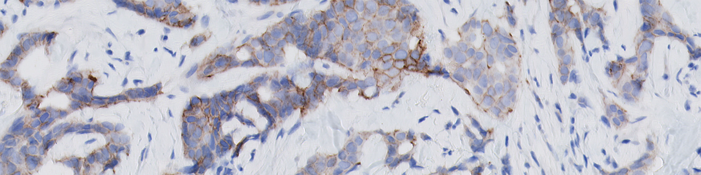 HER2 APP, Breast cancer