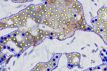 HER2 APP, Breast cancer