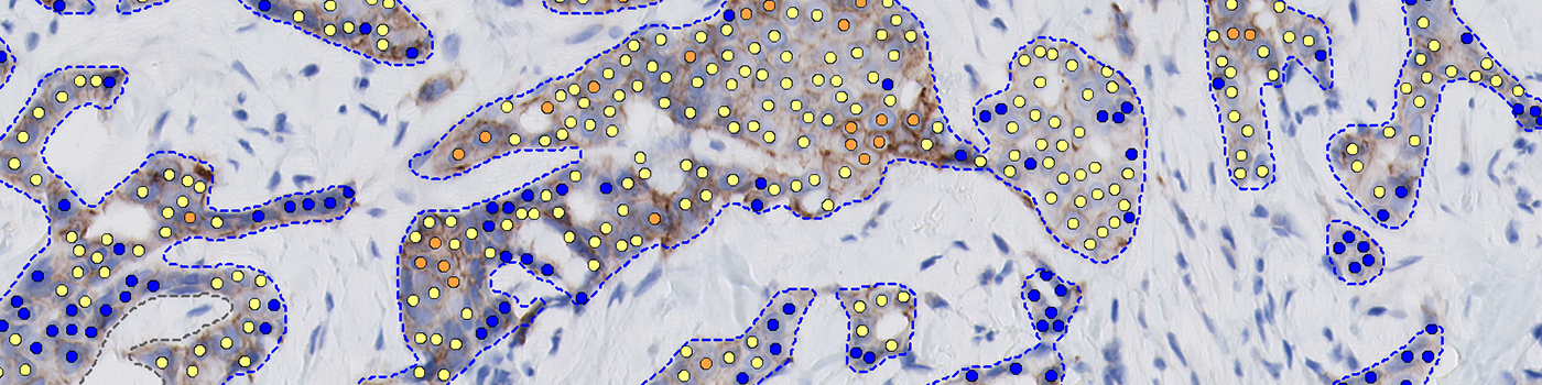 HER2 APP, Breast cancer