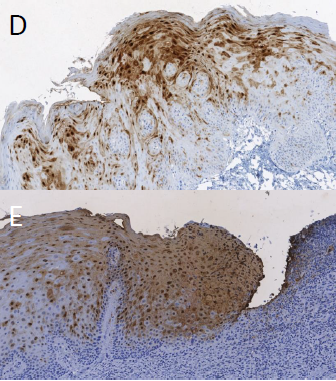 Immunohistochemistry staining of S100A7 biomarker